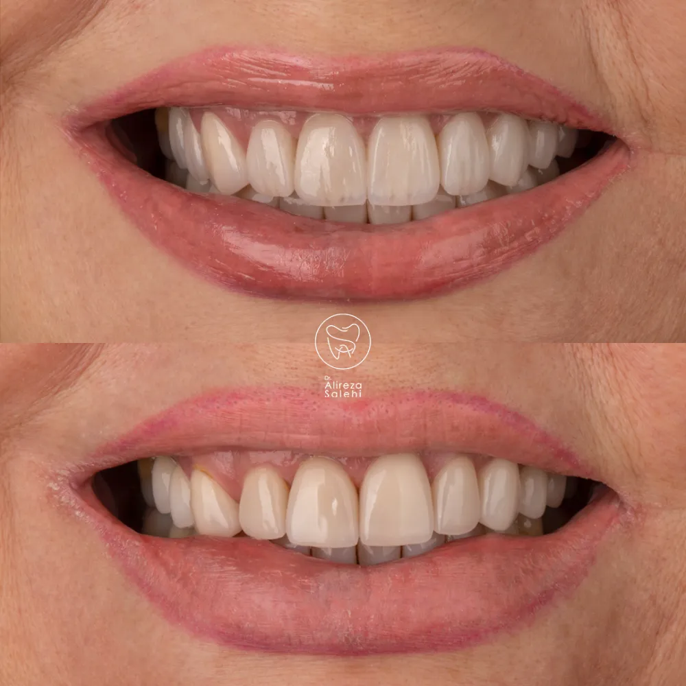 لمینت دندان در کلینیک دکتر صالحی