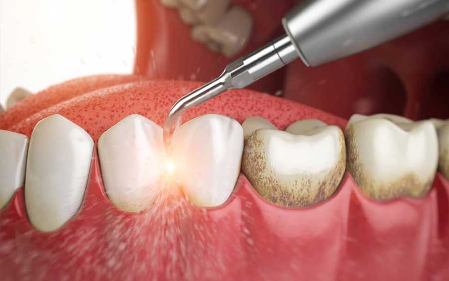 بهترین مراکز جرم گیری دندان در شمال تهران را چگونه انتخاب کنیم؟