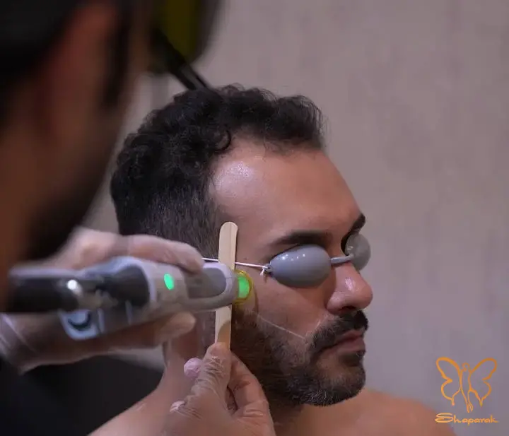 لیزر خط ریش مردانه در کلینیک شاپرک مشهد