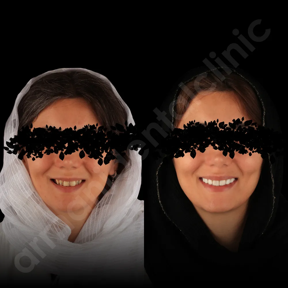 لمینت در کلینیک آرمانی - شهریار