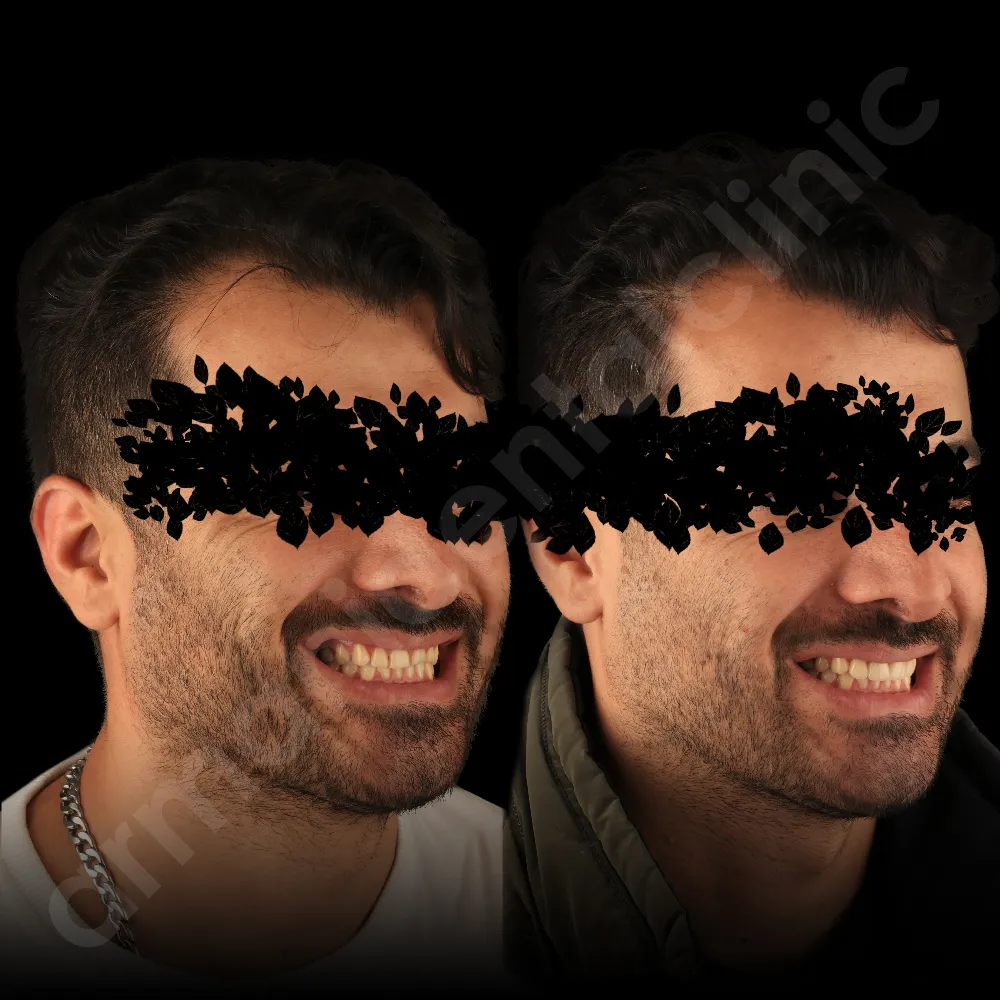 لمینت در کلینیک آرمانی - شهریار