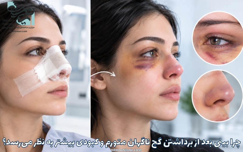 چرا بینی بعد از برداشتن گچ ناگهان متورم و کبودی بیشتر به نظر می‌رسد؟