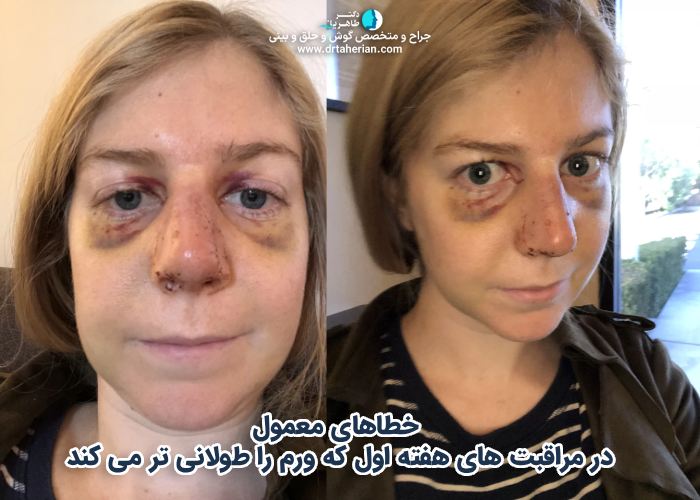 خطاهای معمول در مراقبت های هفته اول که ورم را طولانی تر می کند